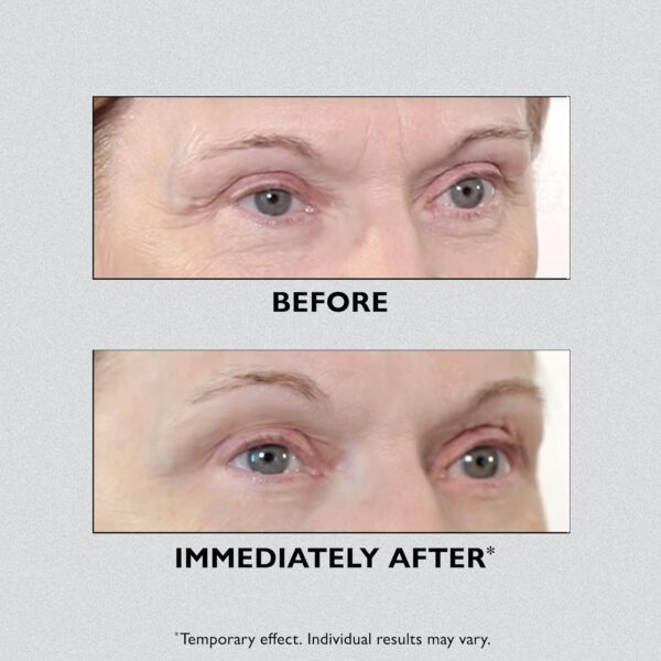 Temporary Eye Tightener